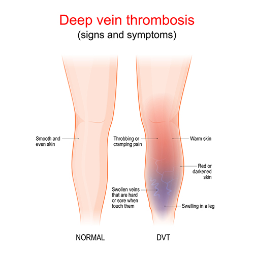 What is Deep Vein Thrombosis (DVT)? - Hill Vascular and Vein Center